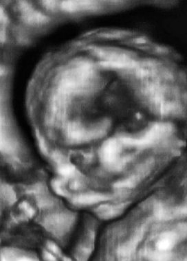 4. Ay Fetüsü 'nün 3D Ultrasonografi Analizi, İtalyan Laboratuvarları