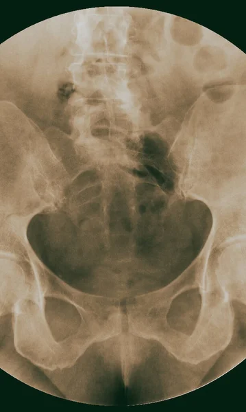 Röntgen Barium Lavemang Undersökning Nedre Gastrointestinala — Stockfoto