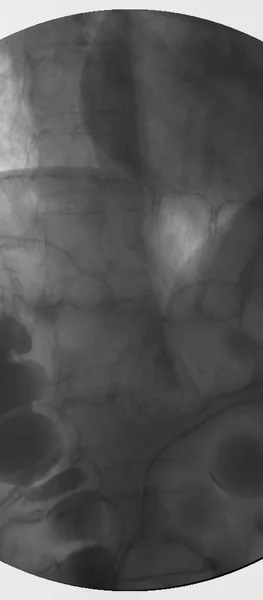Bario Clistere Immagine Colorettale Vista Raggi Che Mostra Anatomico Dell — Foto Stock