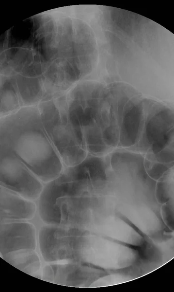 Barium Klysma Beeld Ray Beeld Van Dikke Darm Colorectale Röntgenfoto — Stockfoto