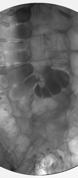 Image Lavement Baryté Vue Radiographique Colorectale Montrant Anatomie Gros Intestin — Photo