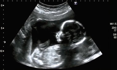 3D Ultrasonografi analizi