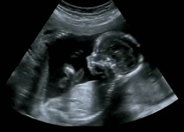 Obstetric Ultrasonography Ultrasound Echography of a first month — Stock Photo, Image