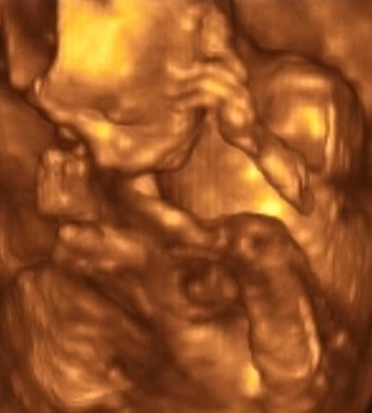 4 ay fetus Ultrasonografi analizleri