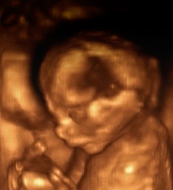 4 ay fetus Ultrasonografi analizleri