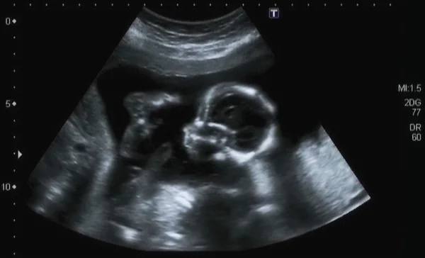 Ultrasonography Analysis of a 4th Month Fetus — Stock Photo, Image
