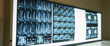 duvar ekran bol x-ray taramaları.