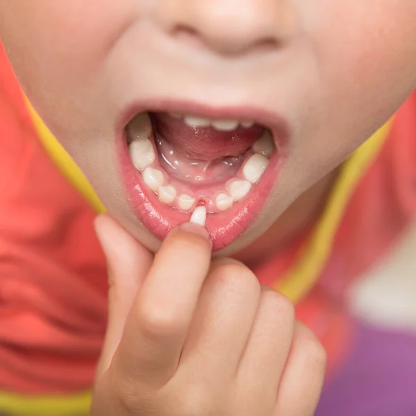Tejelő fogat esett ki a gyermek. — Stock Fotó