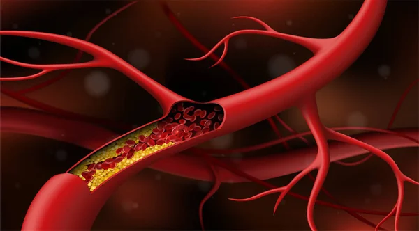 Artéria Bloqueada Pelo Colesterol Ilustração Vetorial —  Vetores de Stock