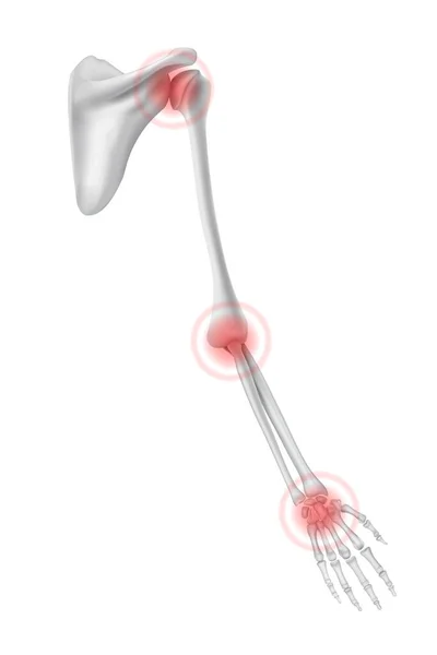Ανθρώπινα Οστά Χεριών Αρθρώσεις Που Επηρεάζονται Από Την Αρθρίτιδα Εικονογράφηση — Διανυσματικό Αρχείο