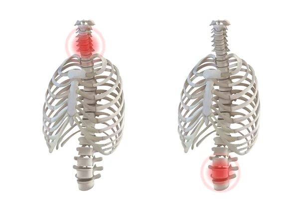 Osteoporose Coluna Vertebral Pescoço Pelve Isolada Fundo Branco Ilustração Vetorial —  Vetores de Stock