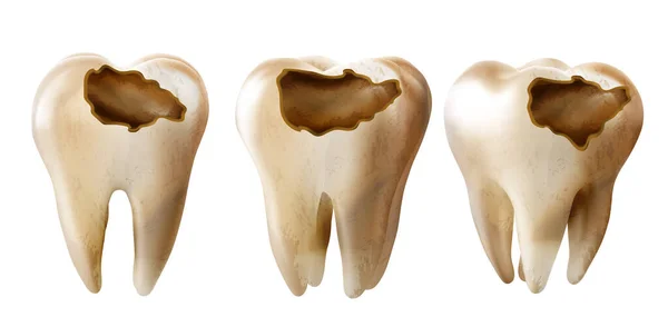 歯の歯科モデル 歯の歯科検査の概念としてのイラスト 歯科健康と衛生 — ストックベクタ