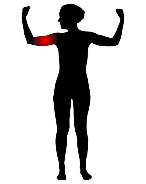 Framifrån Kvinna Med Smärta Överarmen — Stock vektor