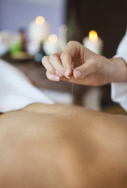 Close up van een hand plaatsen van acupunctuur naalden op achterkant van een vrouw — Stockfoto