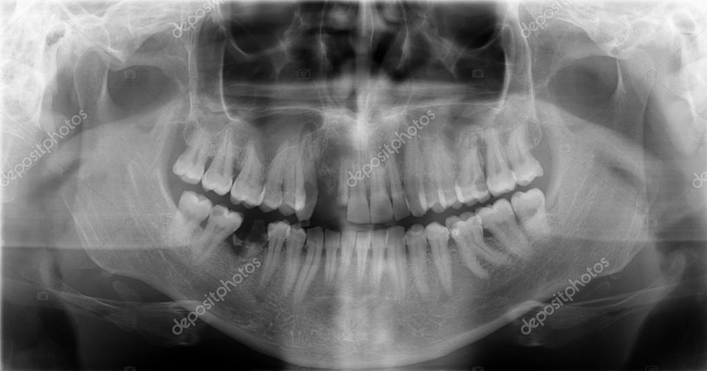 Dental Xray Stock Photo by ©layeroff 67159349