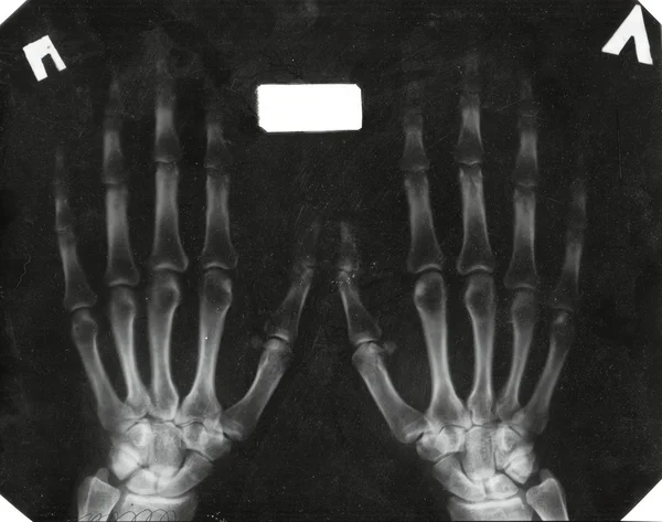 X-ray of the hands — Stock Photo, Image