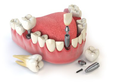 İnsan implant diş. Diş kavramı. İnsan diş ya da protez.