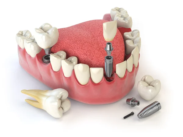 Tooth human implant. Dental concept. Human teeth or dentures. — Stock Photo, Image