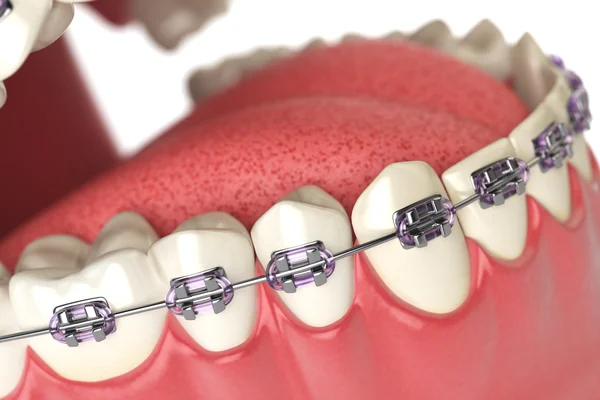 Teeth with braces or brackets in open human mouth. Dental care c — Stock Photo, Image