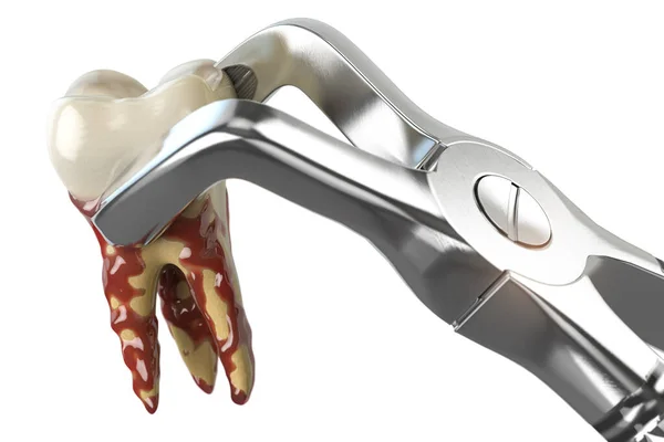 Видалення Зуба Зубними Протезами Ізольовано Білому Тлі Ілюстрація — стокове фото