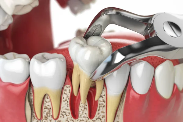 Tooth Extraction Dental Forceps Model Human Jaw Illustration — Φωτογραφία Αρχείου