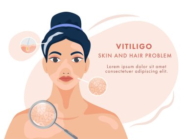 Beyaz Arkaplanda Vitiligo Cildi ve Saç Sorunu Gösteren Genç Kadın Karakteri.
