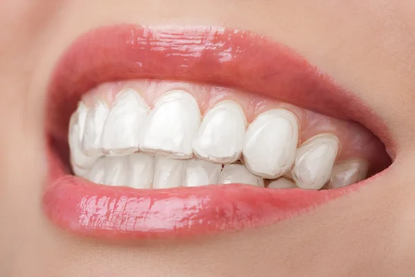 Dientes con bandeja blanqueadora sonrisa dental — Foto de Stock