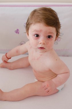  Roseola Infantum döküntü