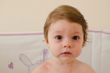  Roseola Infantum döküntü