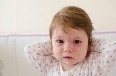  Roseola Infantum döküntü