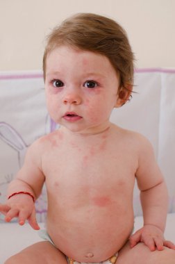  Roseola Infantum döküntü