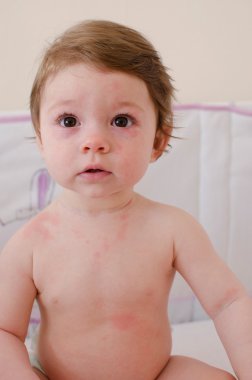  Roseola Infantum döküntü