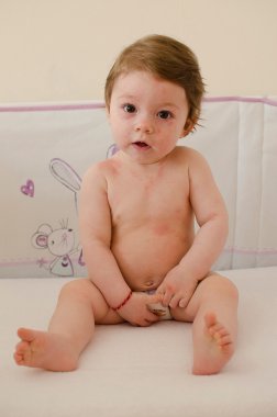  Roseola Infantum döküntü