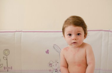 Roseola Infantum döküntü