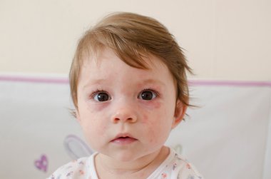  Roseola Infantum döküntü