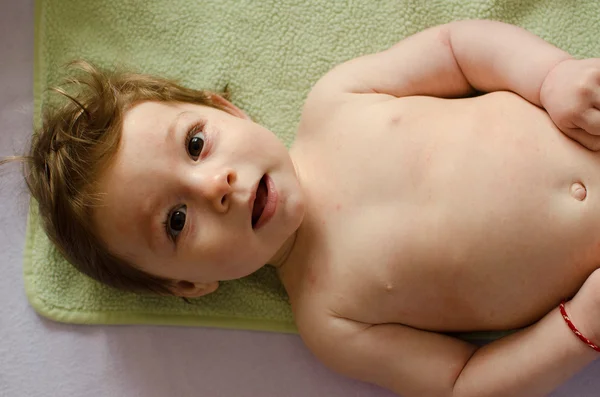 突発性発疹小児発疹 — ストック写真