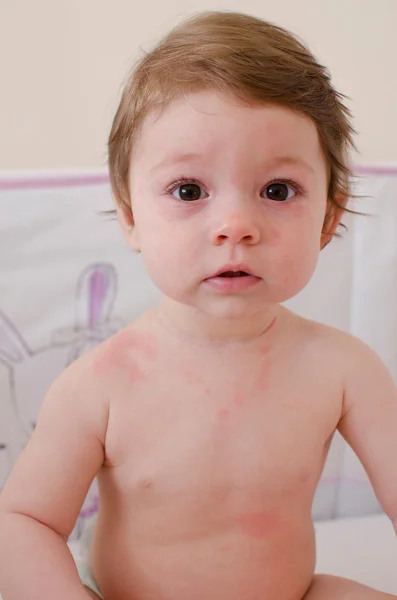 Erupção de roséola infantum — Fotografia de Stock