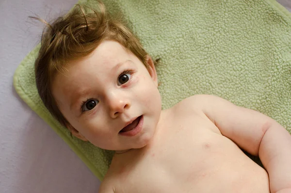 Roseola infantum rash — Stock Photo, Image