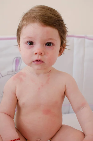 Erupção de roséola infantum — Fotografia de Stock