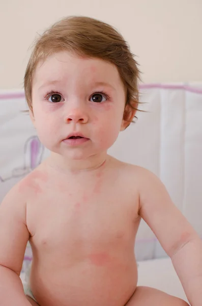 Erupção de roséola infantum — Fotografia de Stock