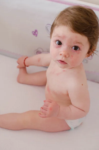 Roseola Infantum Rash Stock Photo By C Dessie Bg