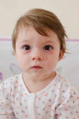  Roseola Infantum döküntü