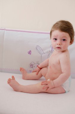  Roseola Infantum döküntü