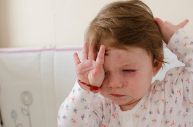  Roseola Infantum döküntü