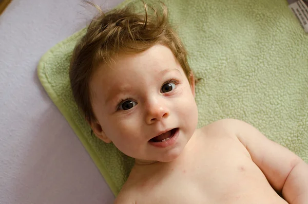 Eruzione cutanea infantum di Roseola — Foto Stock