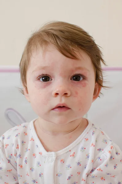 Roseola piel erupción infantil —  Fotos de Stock