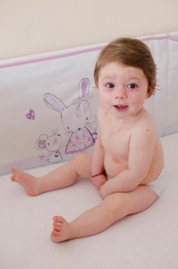  Roseola Infantum döküntü cilt