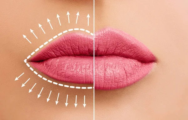 Concept Augmentation Des Lèvres Lèvres Femme Avant Après Les Injections — Photo