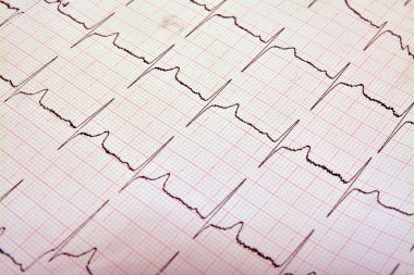 EKG grafiği