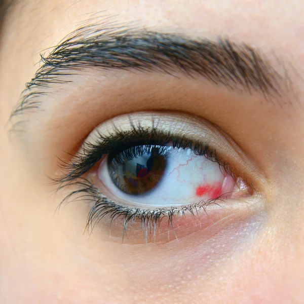 Lesioni oculari rosse — Foto Stock